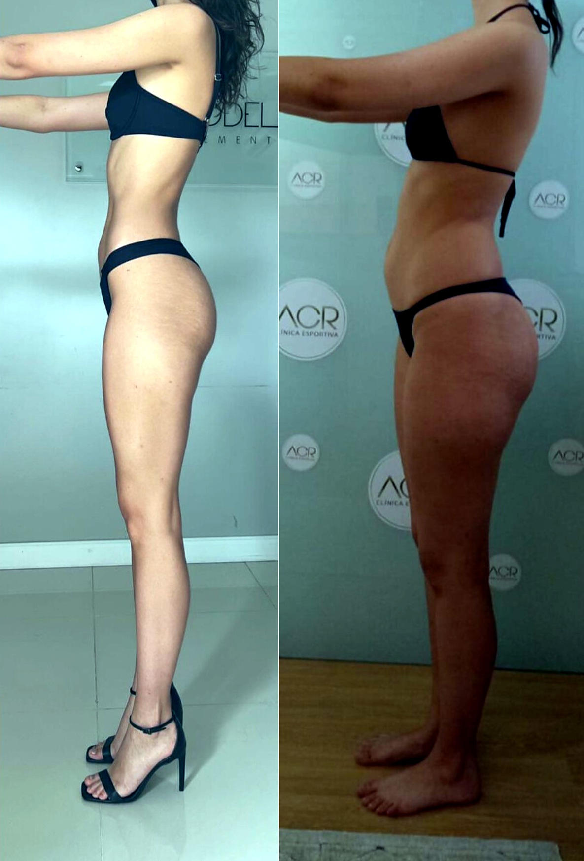 Resultado antes e depois 4 acompanhado pela ACR Clínica
